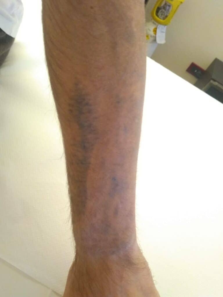 Caso clinico rimozione tatuaggio colorato