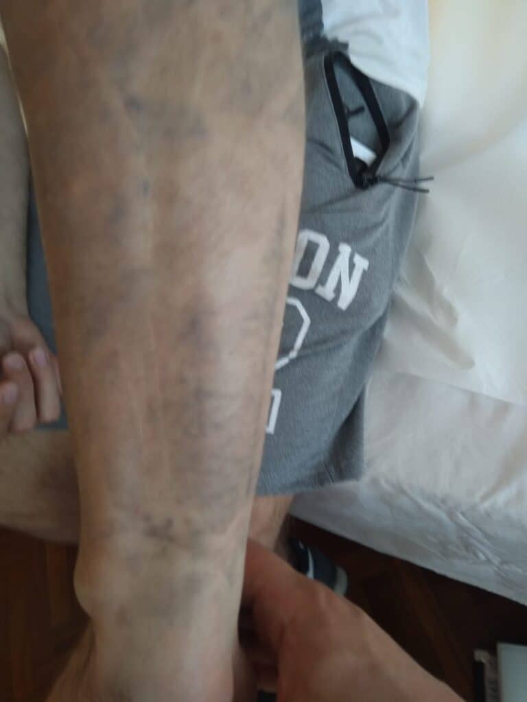 Evoluzione trattamento laser Brescia