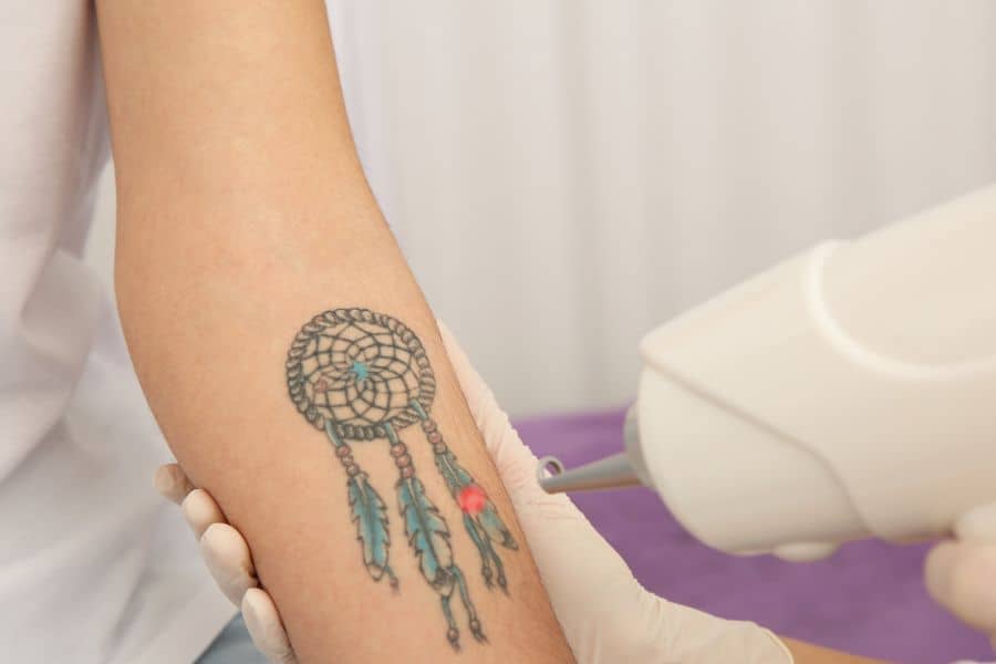 Rimozione Tatuaggio: Effetti Collaterali