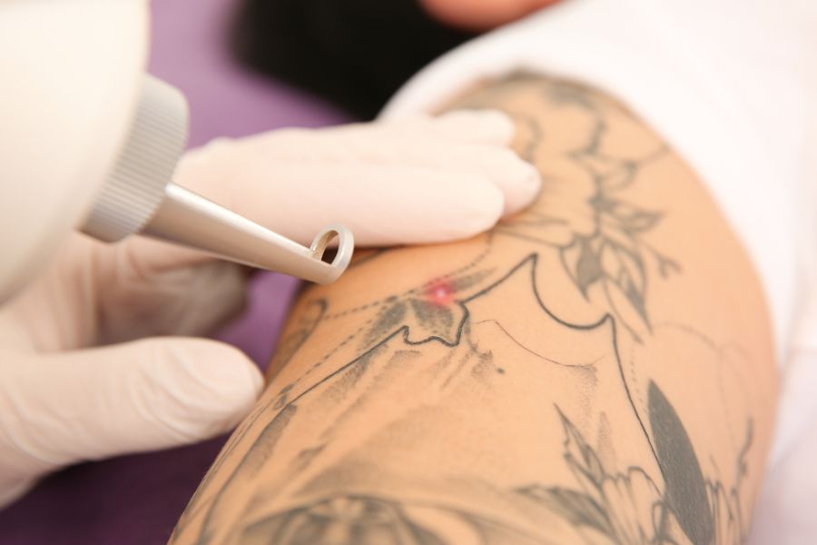 Cancellare un Tatuaggio: Guida Completa alla Tecnologia Laser Q-Switched