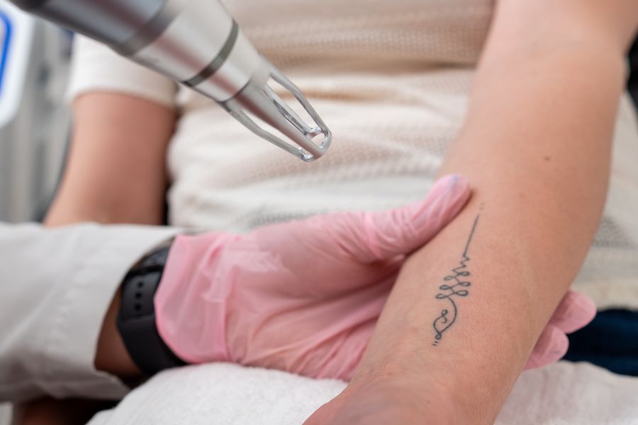 Rimozione Tatuaggi Senza Cicatrici