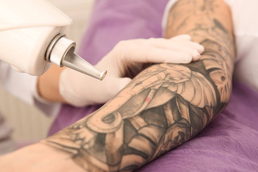 Rimozione Tatuaggi Neri e Scuri
