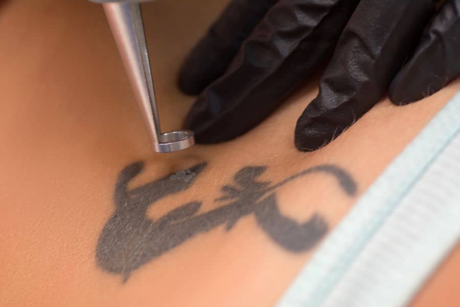 Rimozione Tatuaggi Professionali