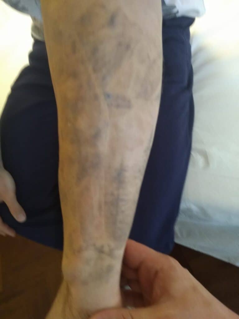 Tatuaggio sul braccio durante il trattamento laser - schiarimento progressivo