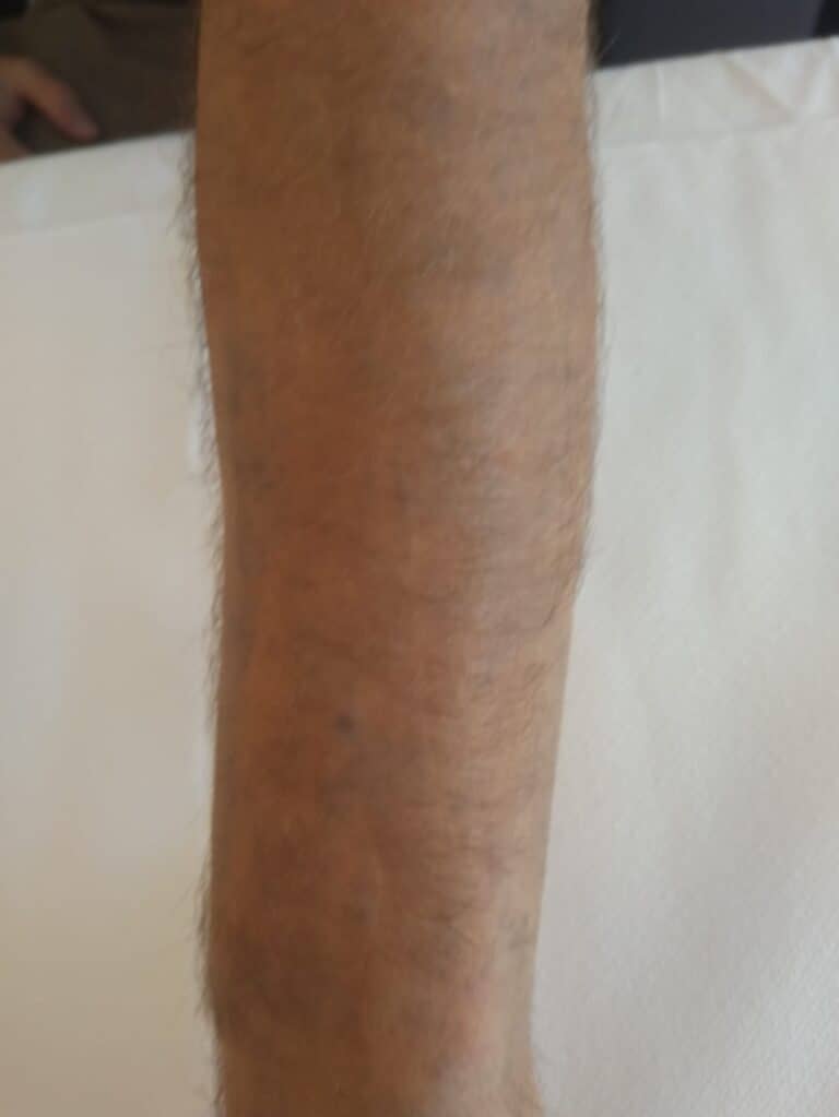 Tatuaggio sul braccio rimosso con laser Q-Switched a Brescia - risultato finale
